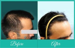 Alopecia doctor in Pune