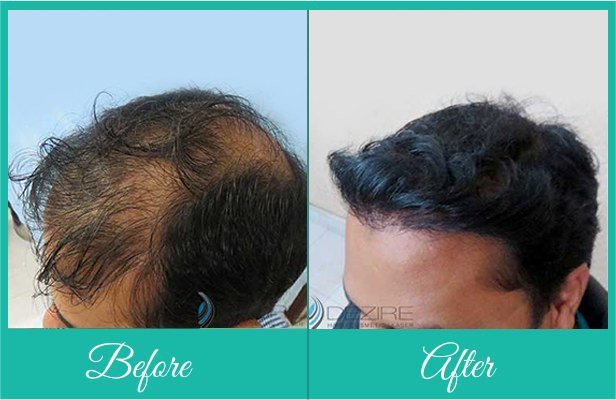 Nido Synthetic Hair Implant in Pune -Cost, Results Pune