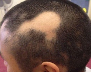 Alopecia treatment in Pune