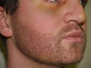 Beard Transplant Pune - Beard Hair Transplant, Facial Hair Implants Plastic Surgery Procedure, Cost, Before and After | Dezire Clinic Pune