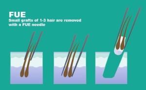 Know the Benefits of MAX FUE Hair Transplant Technique, Doctors Role, FUE Surgical Procedure, Cost, Results and why we are the best in Pune for Max FUE Hair Restoration. Call us for more details.