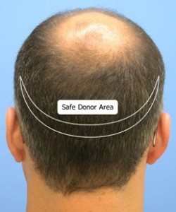Hair Transplant Operation in Pune, Hair Restoration Surgery in Pune, Hair Loss Surgery in Pune, Hair Implant Surgery in Pune, Surgical Hair Transplant in Pune, Surgical Hair Replacement in Pune, Hair Regrowth Surgery in Pune