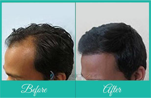 Hair treatments in pune