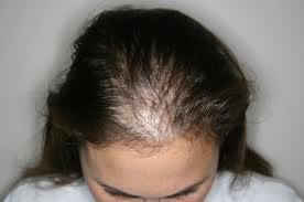 Dezire Clinic is the best clinic in Pune, India for Baldness Cure & Baldness Treatment for Men and Women, We have Best Doctors, Latest Technology, and Successful Hair Transplant Treatment for Women & Men at our Centre. Visit Dezire Clinic today for Free Consultation & Great Deals.