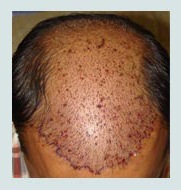 Cure For Baldness Pune, What Causes Baldness Pune, Treatment For Baldness Pune, Bald Treatment Pune, Hair Baldness Treatment Pune, Treatment Of Baldness Pune