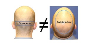 Fue Crown Hair Transplant in Pune - Crown Area Hair Loss Restoration, Cost,Results before and after | Dezire Clinic Pune