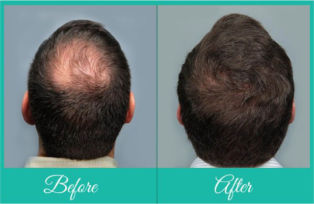 Crown Area Hair Loss Restoration, Cost | Dezire Clinic Pune