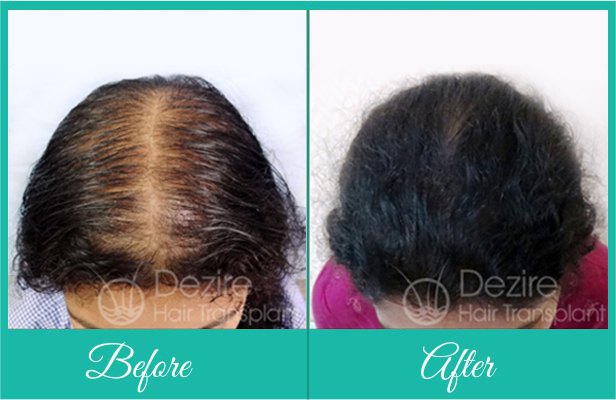 Best Hair Implants for Female in Pune | Dezire Clinic Pune