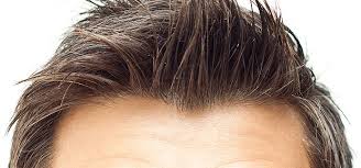 Hair Transplant Front, Hair Thinning At Front, How to Grow Front Hair Line