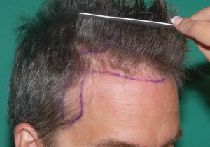 Frontal Hair Transplant in Pune - Frontal Hairline Restoration, Cost, Surgery & Results | Dezire Clinic Pune