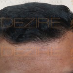 2500 grafts frontal