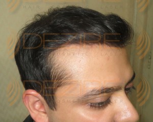Fue hair transplant cost in Pune in rupees