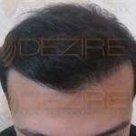 Fut hair transplant cost in Pune in rupees