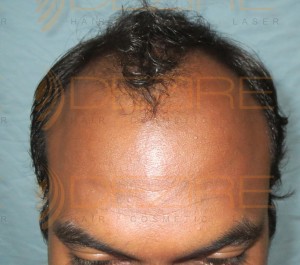 Hair Follicle Surgery