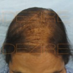 Hair Loss In Women Treatment