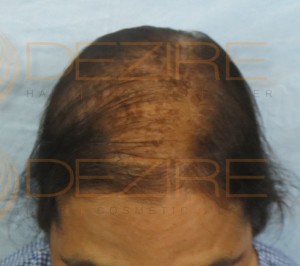 Hair Loss In Women Treatment