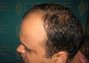 Hair Restoration Doctor in India