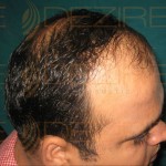 Hair Restoration Doctor in Pune