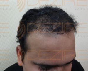 Hair Restoration Physician in India