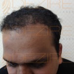 Hair Restoration Physician in pune