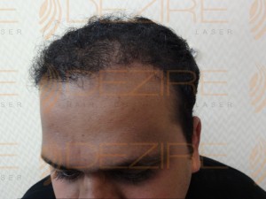 Hair Restoration Physician in pune