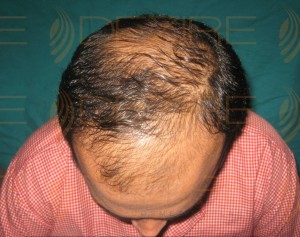 Hair Restoration Surgeon