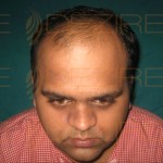 Hair Restoration Surgeon in Pune