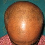 How Much PRP Hair Transplant