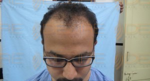 Permanent Hair Replacement