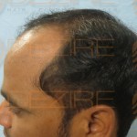 Restore Hair Treatment in Pune