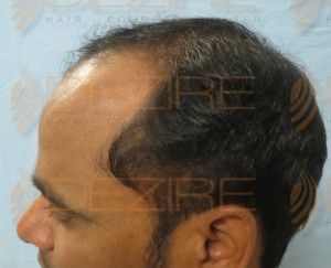 Restore Hair Treatment in Pune