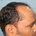 Restore Hair Treatment in Pune near