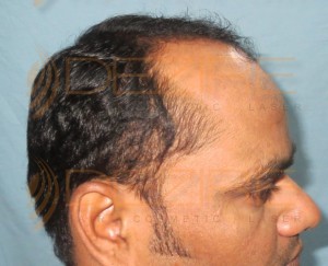Restore Hair Treatment in Pune near