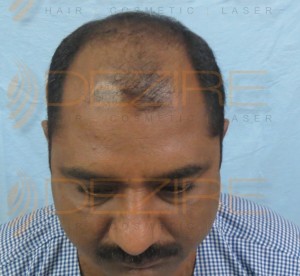 Where To Get A Hair Transplant