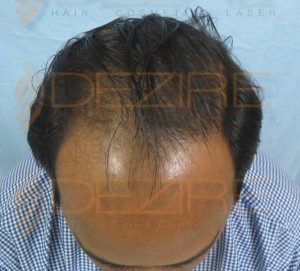 Where To Get A Hair Transplant in Pune
