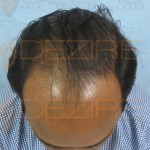 Where To Get A Hair Transplant in Pune