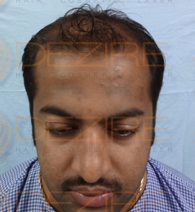 Where To Get Hair Transplant