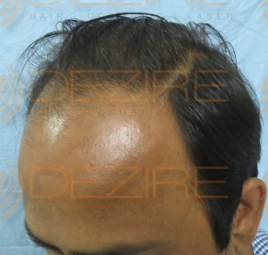 Where To Hair Transplant in Pune