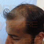 Which type Hair Transplant