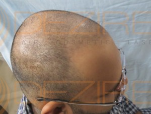 after hair transplant surgery