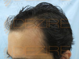 are female hair transplants successful