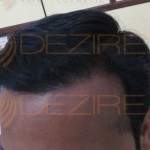 are hair transplant scars permanent