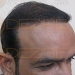 bald spot with no hair follicles