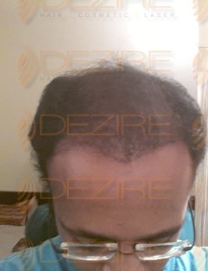 best doctor for hair fall treatment in pune