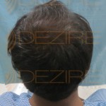 best doctor for hair transplant in india