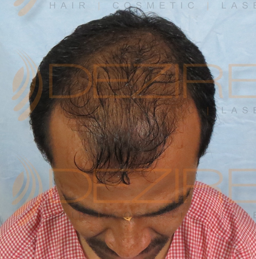 best hair tonic for thinning hair – Hair Transplant Pune