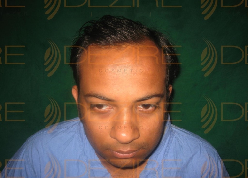 Transplanted Hair Growth done at Dezire Clinic Pune | Hair Transplant Pune
