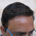 best hair transplant method in india