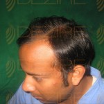best hair transplant results ever