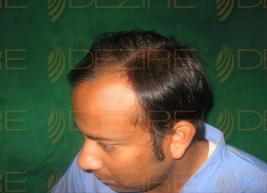best hair transplant results ever